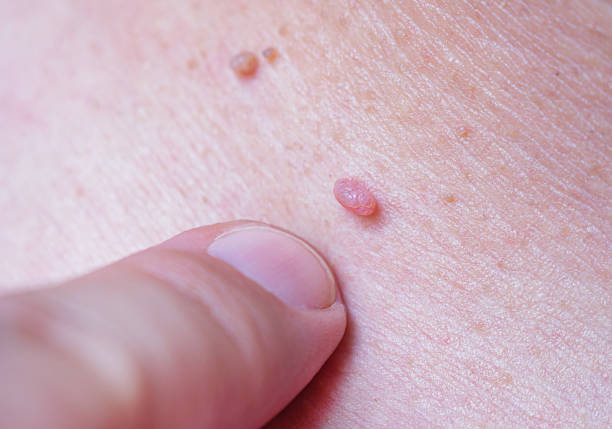 Papiloame: excrescențe benigne cu soluții simple și eficiente