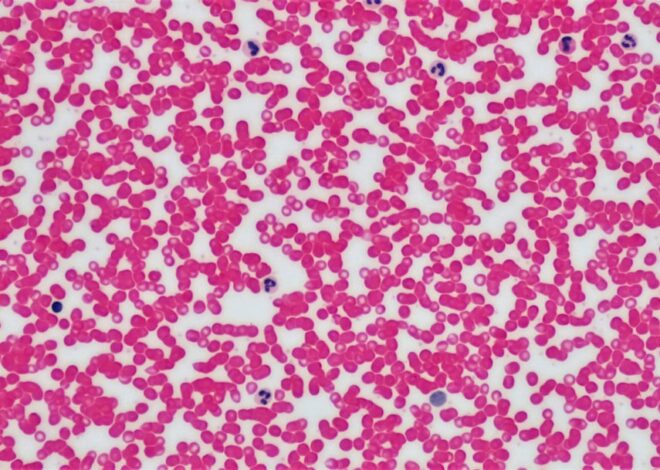 ce este lupusul eritematos sistemic