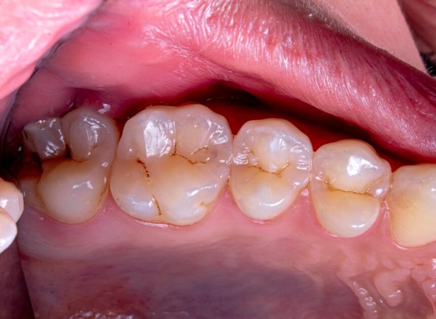 Top 10 metode de prevenire a cariilor: Ghidul complet pentru o dantură sănătoasă