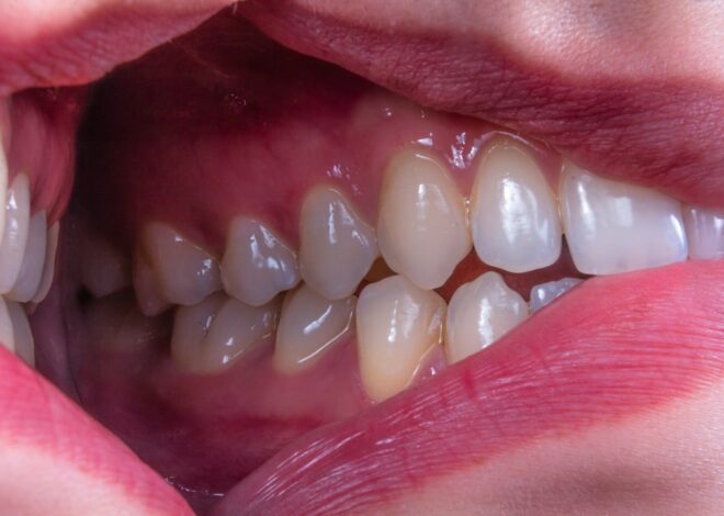 Tratamentul gingivitei la adulți