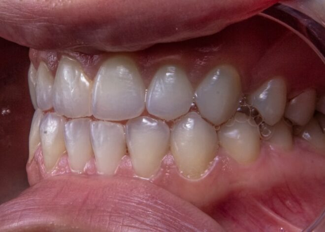 Albire dentară la cabinet: procedura eficientă