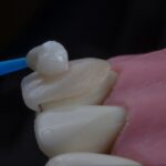 Cum să cureți protezele dentare eficient