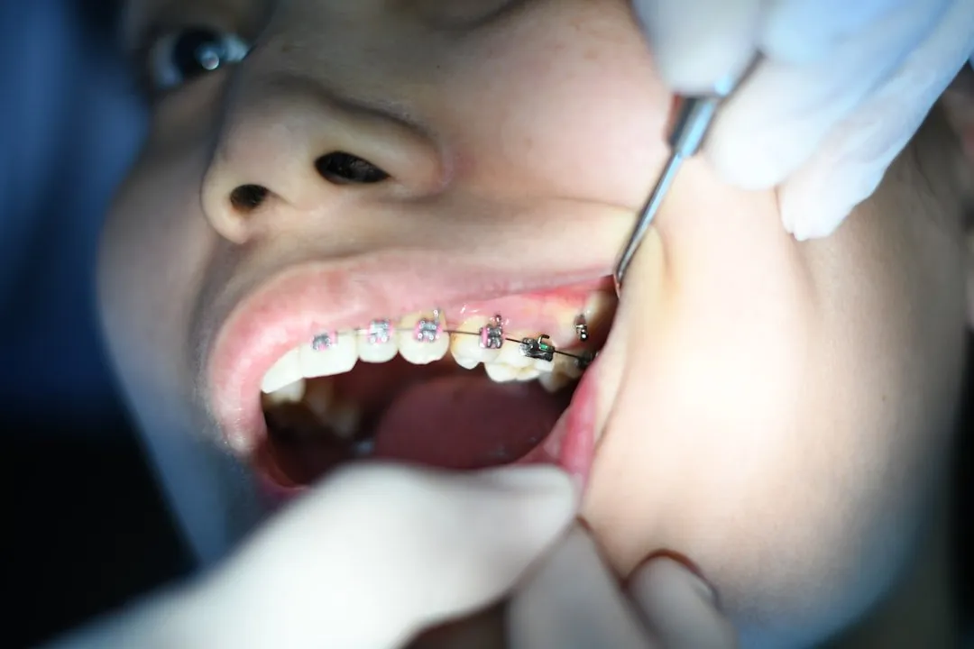 Photo prevent cavities