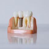 Ce trebuie să știi înainte de un implant dentar, dincolo de preț — MEDANET
