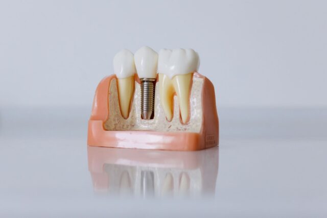 Ce trebuie să știi înainte de un implant dentar, dincolo de preț — MEDANET