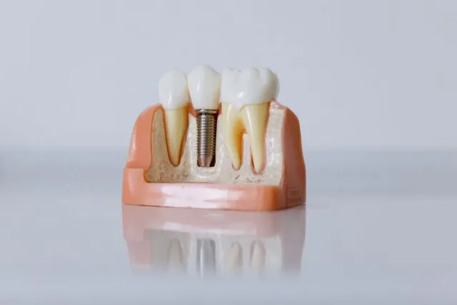 Ce trebuie să știi înainte de un implant dentar, dincolo de preț — MEDANET